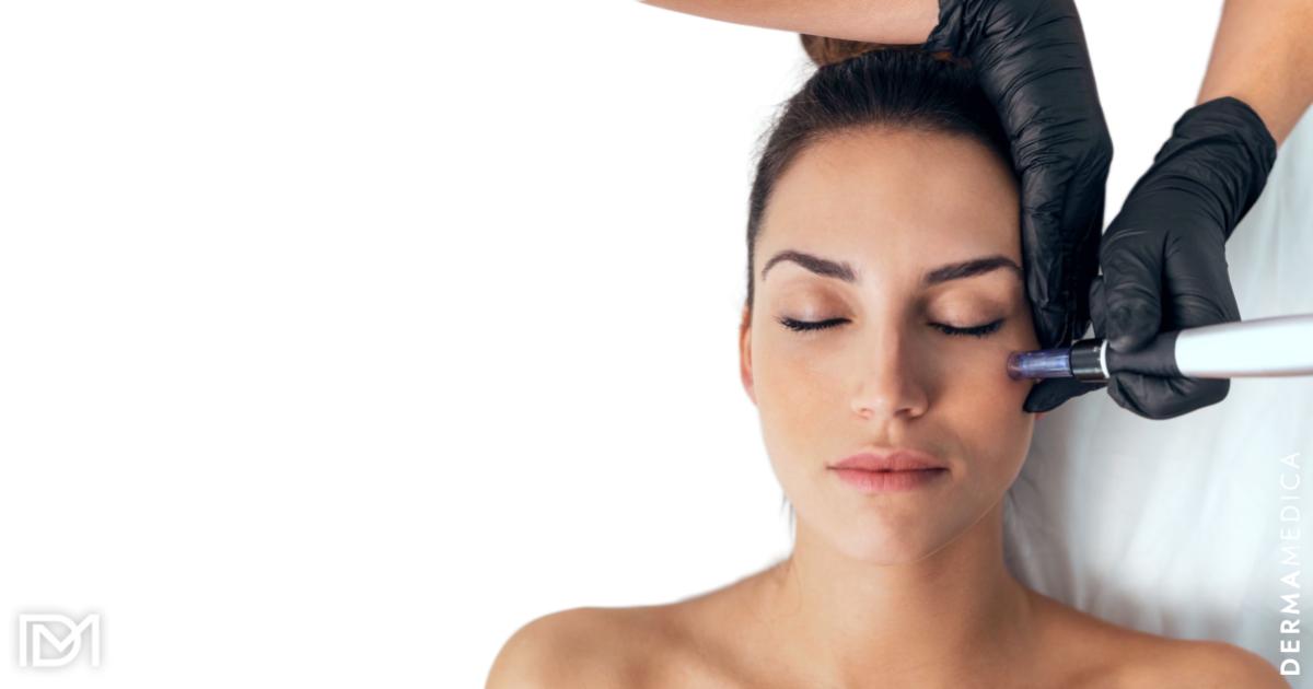 Microneedling